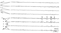 Du tar EEG av pasient med mulig epilepsi. Hvilken type anfall tror du denne pasienten har?