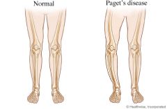 -Progressive bone disease


-Excessive bone remodelling


-Pelvis, spine, skull or leg bones.


-Men more likely
