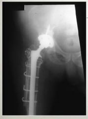periprosthetic femur fracture, with a loose femoral stem, and a Paprosky IIIA femoral defect. This is best treated with a fully-coated cementeless stem with metaphyseal onlay allograft, Type IIIA: severe metaphyseal bone loss with greater than 4 c...