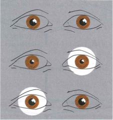 what would produce this effect? (when shined into left eye, both eyes constrict; when shine into right eye, neither eye constricts)