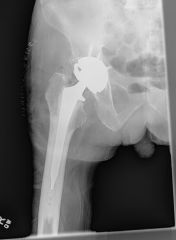 two greatest factors contributing to the instability include the patient's dementia and the posterior approach to the hip. The posterior approach has been shown in numerous studies to lead to a greater rate of dislocation in both hemiarthroplasty ...