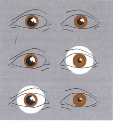 what would produce this effect? (right eye doesn't constrict no matter what)