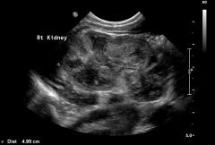 Which renal pathology? *this image is a pediatric case