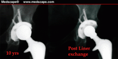 osteolytic lesions behind the acetabular cup and eccentric wear of the polyethylene with superior migration of the femoral head within the cup. Options 1 and 2 are poor choices because the osteolysis must be addressed to prevent further bone loss ...