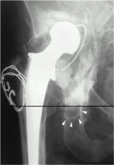 Fig A hip xray of a 72yo F who had had a R THA 15 yrs previously. CT imaging of the affected hip shows non-contained defects in both the anterior and posterior columns of the peri-acetabular region affecting >50% of the wt bearing surface. Which o...