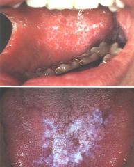 Immune System Disorders:
Lichen Planus