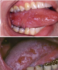 Immune System Disorders:
Speckled Leukoplakia