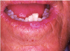 Immune System Disorders:
Leukoplakia of the Lower Lip