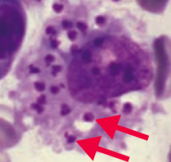 Leishmania donovani (protozoa)
- Transmitted via sandfly
- Diagnose via presence of macrophages containing amastigotes (picture)
- Treat with Amphotericin B and Sodium Stibogluconate