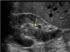 Which renal neoplasm? *note echogenic material filling the ureter
