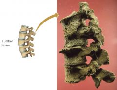 These lumbar vertebrae illustrate _____________, a common problem resulting from physically demanding activity.