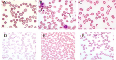 C: 
- Macro-ovalocytes 
- Shows pronounced variation in cell size and shape 
- Tear-drop cells
* Megaloblastic Anemia