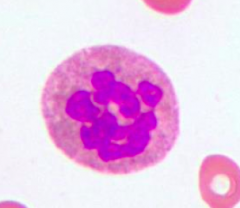 Hypersegmented neutrophil (>5 nuclear lobes)
= Megaloblastic Anemia