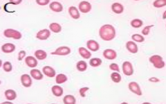 * Hypersegmented neutrophils (1st)
- Macrocytic anemia w/ oval macrocytes
- Anisopoikilocytosis (variable size and shape)