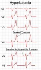 Hyperkalemia


Tall T waves, prolonged PR interval, absent P waves, wide/bizarre QRS


You would want to stablize the hyperkalemia first- give 3cc/cat of calcium gluconate immediately.