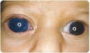 enlargement of the eye (seen in children with congenital glaucoma