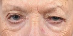 excessive eyelid skin caused by loss of elastic tissue