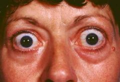 a protrusion or forward bulging of the eye with retraction of the eyelid