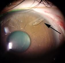 insertion of a tiny plastic tube from the anterior chamber to reservoir that is placed halfway back around the eye for treating glaucoma