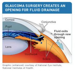 surgical procedure for glaucoma that creates a bypass drain which is located in the sclera under the upper lid