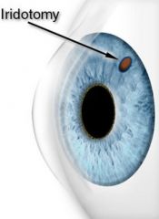 laser beam makes a small hole in the iris allowing an alternate route for aqueous flow