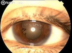 occurs during uveitis when the swollen iris adheres to peripheral cornea (anterior synechia)