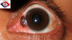 malignant growth on the eyelids and conjunctiva