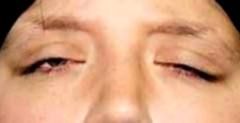 eyelid retraction or downward gaze, ocular symptom of exophthalmos