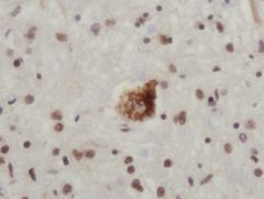 Ubiquitin stain.  What is this lesion?