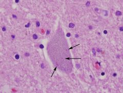 Skein-like inclusion seen in (specific for) Amyotrophic lateral sclerosis (ALS).  
Bunina body pictured above. 
Dysfxn and death of motor neurons. 
degeneration of pyramidal tracts consisting of loss of axons w/ secondary breakdown of myelin sh...