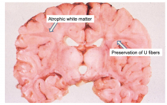 Krabbe's Globoid Cell Leukodystrophy 
Atrophic brain, firm white matter, atrophic white matter with preservation of "U" fibers