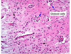 Globoid cells in Krabbe's Globoid Cell Leukodystrophy