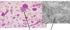 Characteristics of Krabbe's Globoid Cell Leukodystrophy