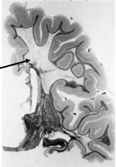 Marked loss of myelin
Preservation of "U" fibers (subcortical fibers)