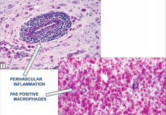 Adrenoleukodystrophy
- Perivascular inflammation
- PAS positive macrophages