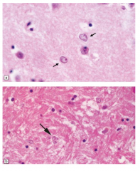 Hepatic Encephalopathy 
Alzheimer type II astrocytes