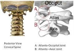 - between the occiput and atlas (first vertebra)