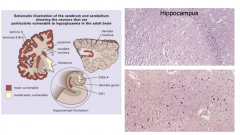 Hypoglycemia
- bottom picture is dentate nucleus
