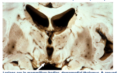 Wernicke Encephalopathy
Lesions are in the mammillary bodies, dorsomedial thalamus, and around the 3rd and 4th ventricles
Acutely - gray-brown discoloration with petechial hemorrhages
Chronic - Atrophy and discoloration of mammillary bodies