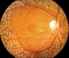 laser burns in the peripheral retina to reduce swelling and risk of bleeding