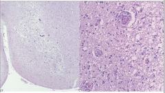 Pallor
Myelin Loss
Prominent Vessels
Macrophages
Relative Preservation of Neurons
