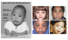 Fetal alcohol Syndrome