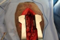 When performing a median sternotomy as seen in the image below, the surgeon will use the retractor seen in the image. What is its name?