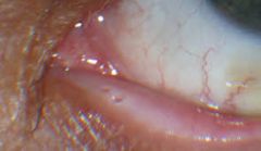 small holes in the upper and lower lid margin (tear drain) near the nasal canthus