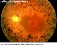 bilateral, hereditary, progressive degeneration of the retina, mainly the rods, leaving the patient with "tunnel vision"