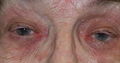 age related drooping of an eyelid