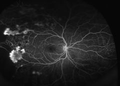 neovascularization in the eye as a result of sickle cell disease