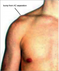-the clavicle is being pushed up, or the acromion is being pushed down
-visible bump above the shoulder