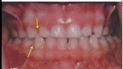 between the canine and the 1st premolar primary dentition