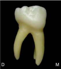 mandibular 1st molar (mesial side)